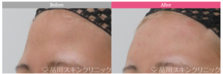 ヒアルロン酸（額）