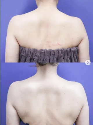 肩ボトックス