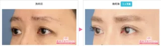 タルミ取り併用全切開法二重・眼瞼下垂+二重