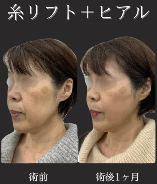 糸リフト+ヒアルロン酸注入