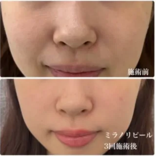 ミラノリピール3回コース