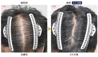 AGA薄毛治療