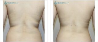 ベイザーリポ2.2脂肪吸引