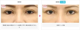 リジュランi