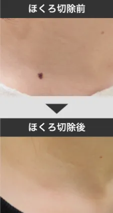 ほくろ切除