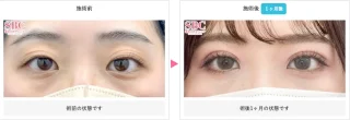 線留めクロス二重術