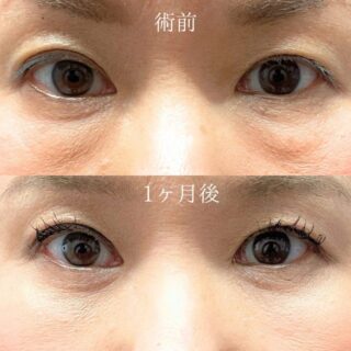 切らない目の下のクマ取り・目の下のたるみ（ふくらみ）取り