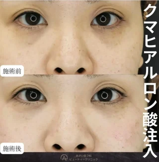 下まぶたヒアルロン酸注入