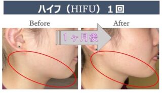 HIFU(ハイフ)