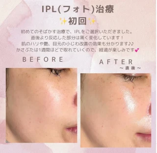 IPL(フォト)治療