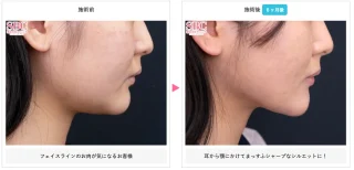 顔の脂肪吸引