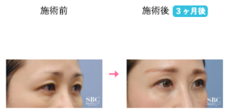 眉下リフト