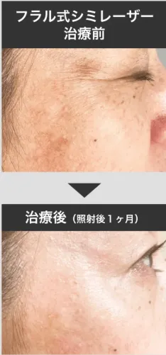 フラル式シミレーザー治療