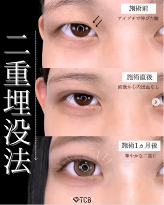 TCB式1dayクイックアイ