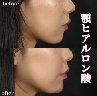 顎ヒアルロン酸注入