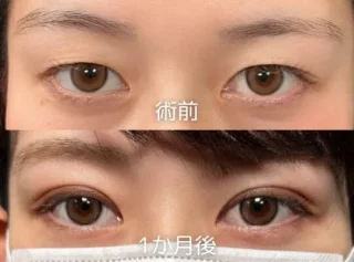 二重埋没法　6点自然癒着法