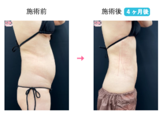 Aquicell（アキーセル）脂肪吸引