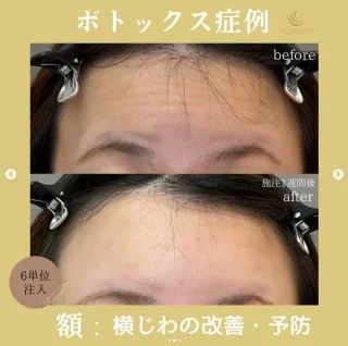 額ボトックス