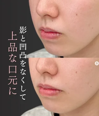  貴族フィラー