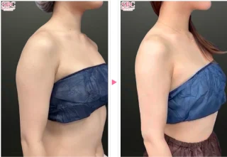 美ボディ脂肪吸引