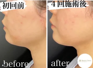 脂肪溶解注射
