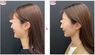 根こそぎVASER脂肪吸引
