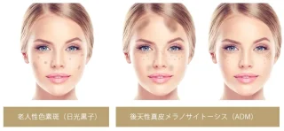 しみ治療