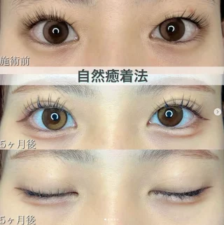 二重埋没法　自然癒着法