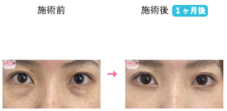 目の下の切らないクマ・たるみ（ふくらみ）取り 他
