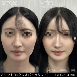 糸リフト（4Dクレオパトラリフト）