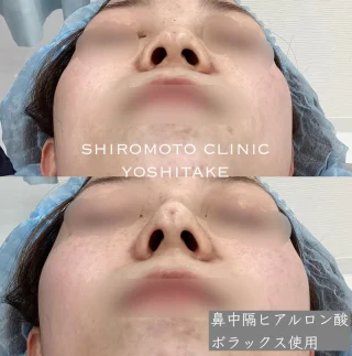 鼻先ヒアルロン酸