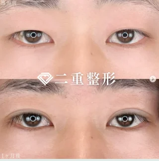 TCB式1dayクイックアイ プレミアムエタニティ