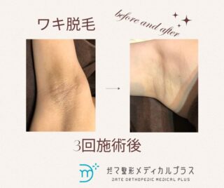 ワキ脱毛