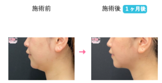 小顔用脂肪吸引注射