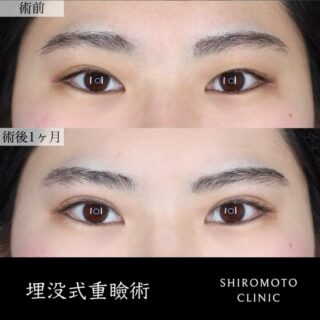埋没式重瞼術(4点留め)