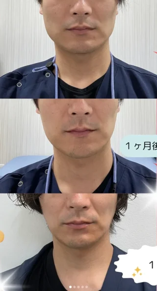エラボトックス