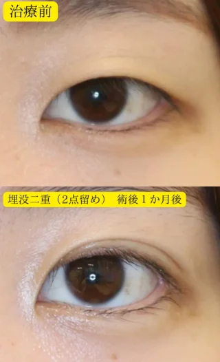 埋没二重(二点どめ)