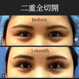 二重全切開