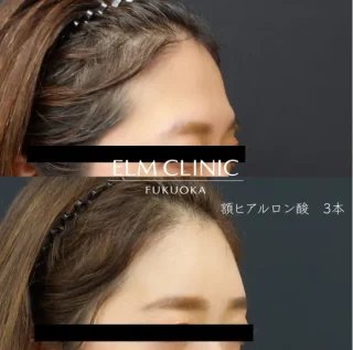 額ヒアルロン酸注入