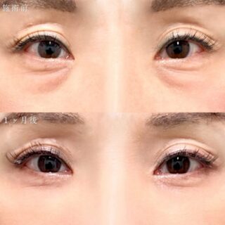 切らない目の下のクマ取り・目の下のたるみ（ふくらみ）取り