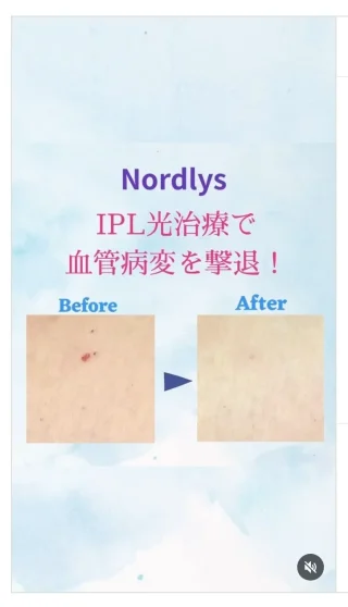 Nordlys(IPL)による赤いほくろ(老人性血管腫)治療