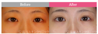 ナチュラル法3点留め