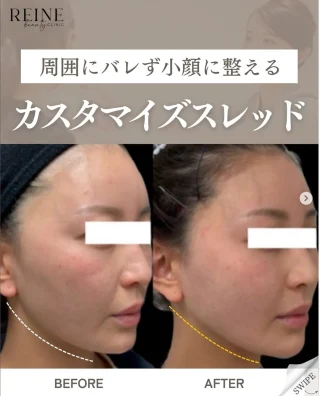 糸リフト