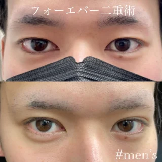 埋没法二重術(切らない二重術)
