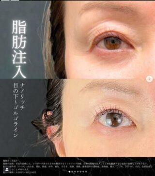 脂肪注入