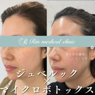 ジュベルック×マイクロボトックス