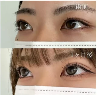 二重埋没法