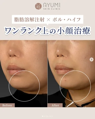 脂肪溶解注射×ボルニューマ