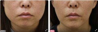 咬筋BOTOX・顎シリコンプロテーゼ・頬吸引