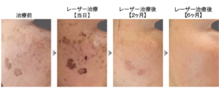 レーザー治療